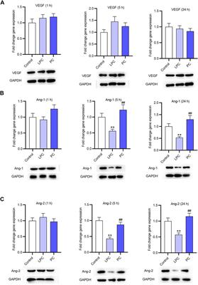 The Inhibitory Effect of Lysophosphatidylcholine on Proangiogenesis of Human CD34+ Cells Derived Endothelial Progenitor Cells